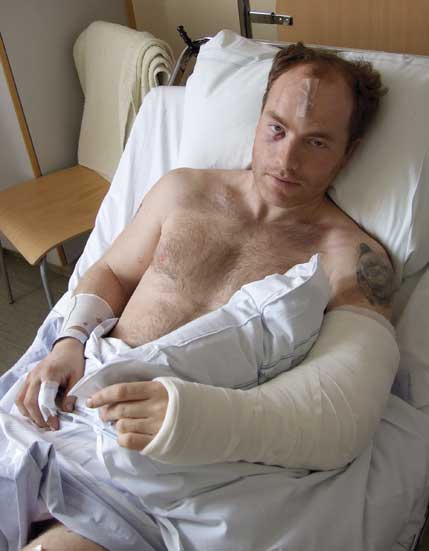 Johnny Smedbergs röjsåg fick en björnhona att komma ut ur idet. Kirurger fick jobba hårt för att rädda hans vänsterarm som slets sönder av den hundra kilo tunga björnen.