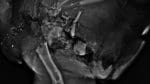 Röntgenbild på en vildsvinsbog där en vanlig, obondad blykula träffat överarmsbenet och fragmenterat kraftigt. Blyfragmenten syns som vita små prickar på ett relativt stort område från halsregionen till armbågsspetsen.